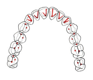 Occlusal Equilibration Guide